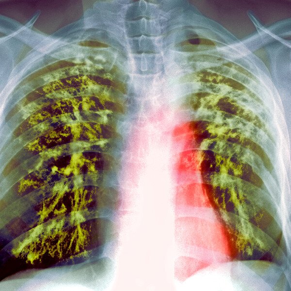 lung-infections-in-pallikaranai-medavakkam-mambakkam