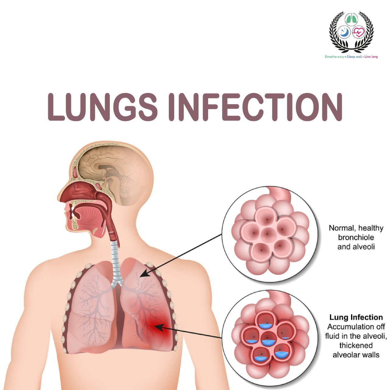 Lung Infections in Adyar Lung Infections in Thuraipakkam