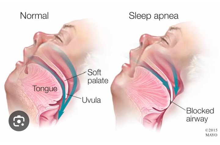Obstructive-sleep-apnea-in-sholinganallur